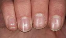 Волнистые ногти на руках: причины деформации